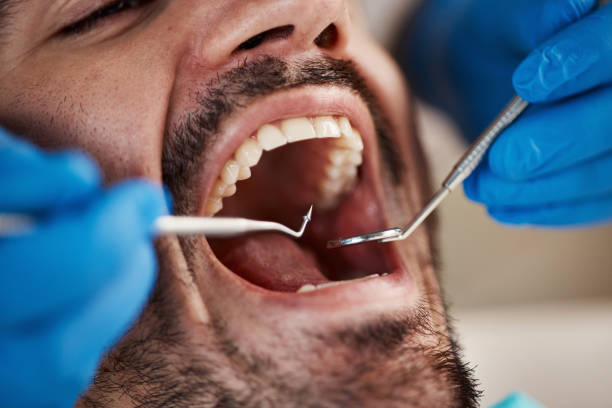 Best Emergency Tooth Extraction in Avery Creek, NC