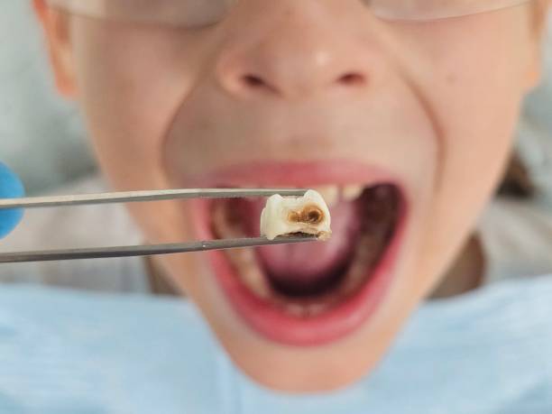 Best Emergency Tooth Extraction in Avery Creek, NC